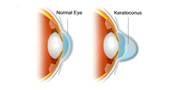 Keratoconus is a condition that causes distortion in the shape of the cornea, the front surface of the eye.