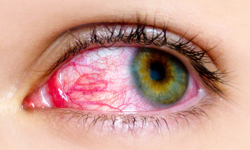 Common red eye conditions such as this can be readily diagnosed and treated by our therapeutically-endorsed optometrist.