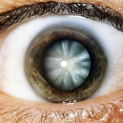 Eye Health Conditions - Cataract, Glaucoma, AMD, Dry Eye, Retinal Lesions