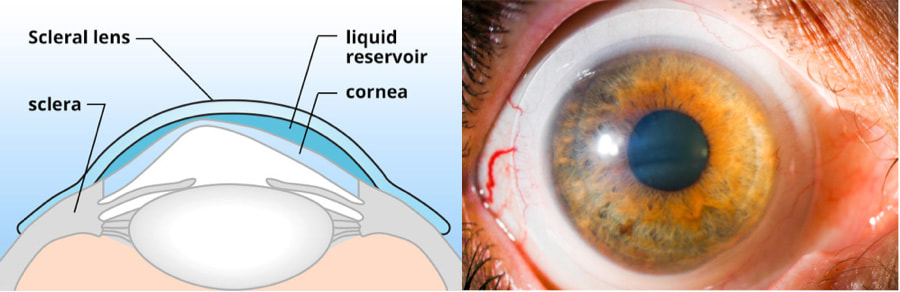 scleral contact lenses keratoconus